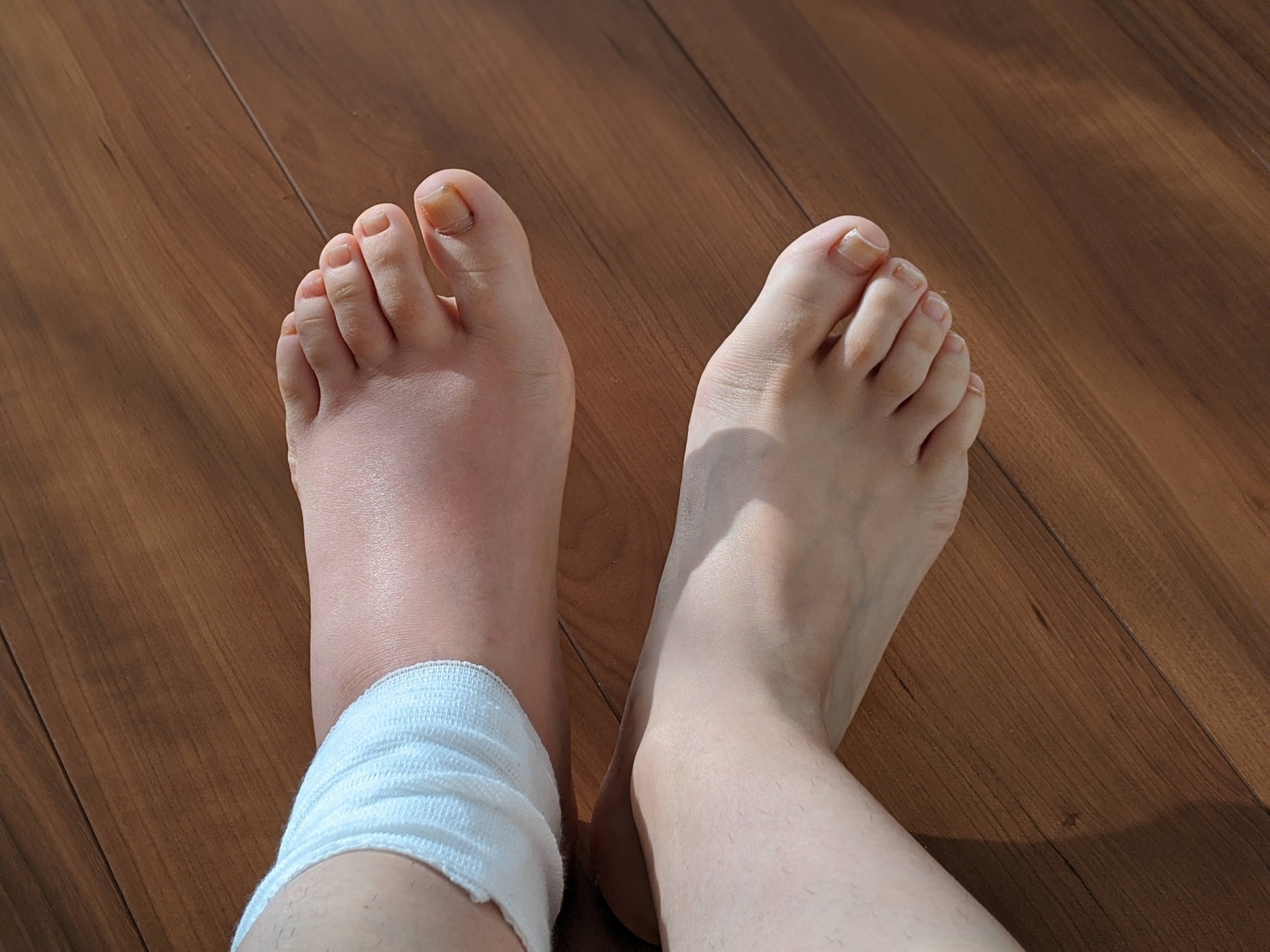 捻挫とは 足の腫れを早く引かせるには 捻挫への対処法も解説します I Fit
